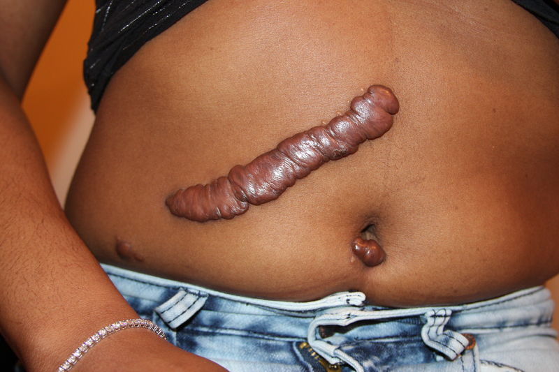 Soubor:Keloid, Post Surgical.JPG