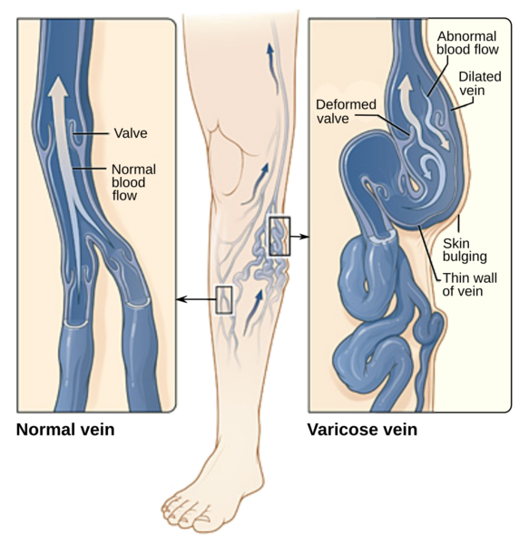 Soubor:Varicose veins-en.png