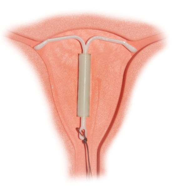 Soubor:Mirena IntraUterine System.jpg