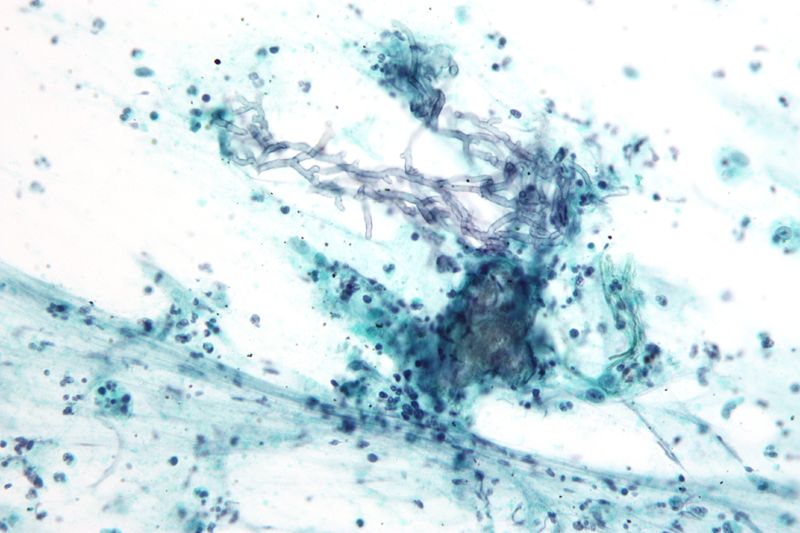 Soubor:Pulmonary aspergillosis cytology.jpg